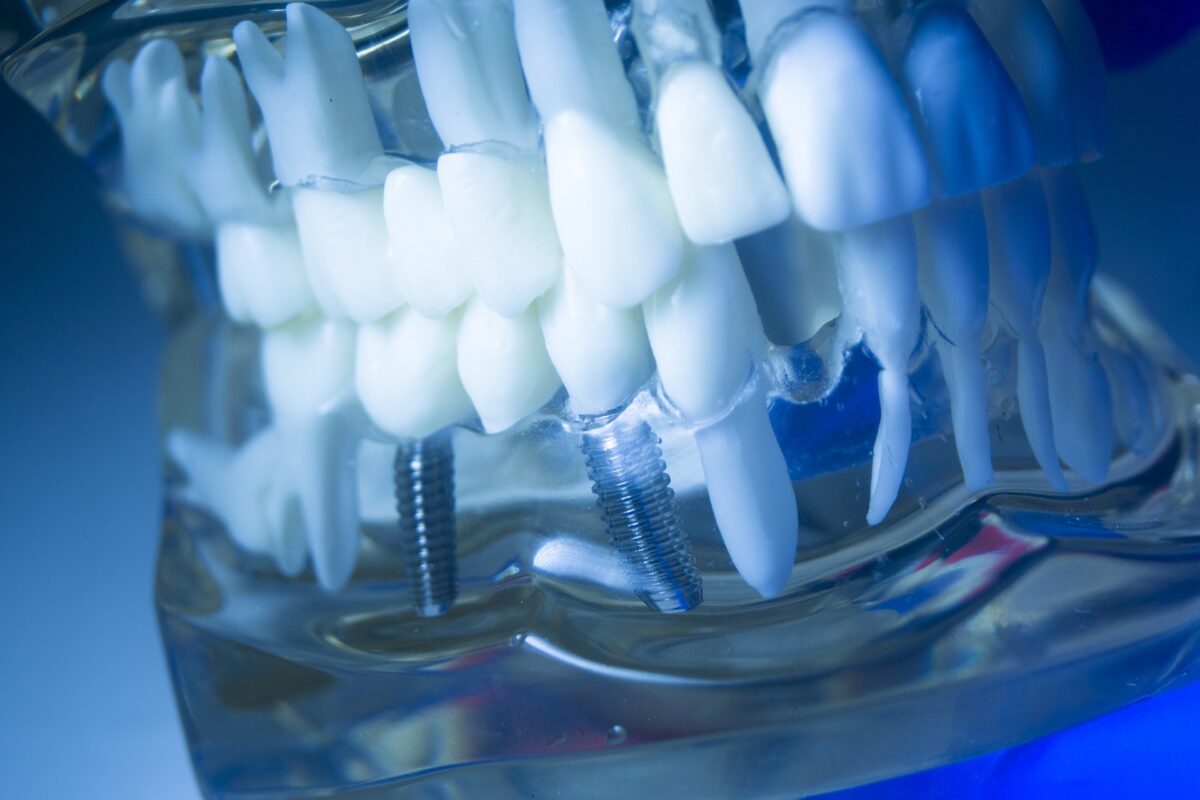 インプラントとは