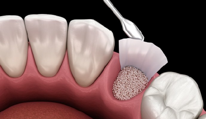 GBR（骨誘導再生法）