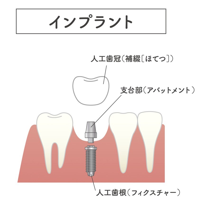 インプラント治療