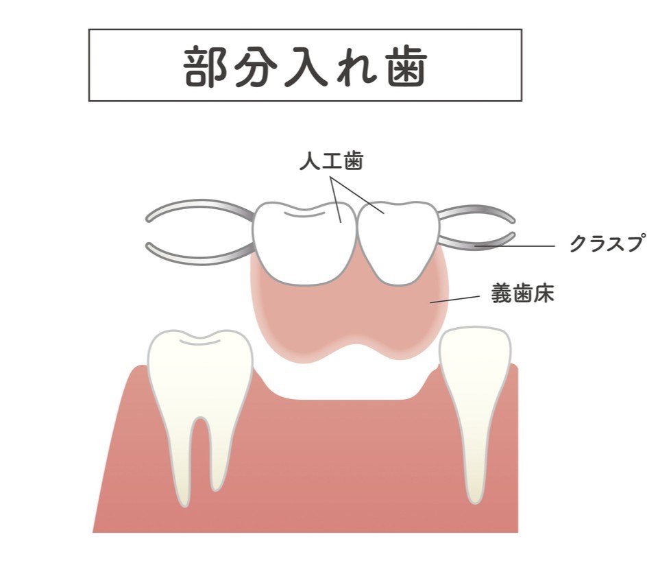 入れ歯治療