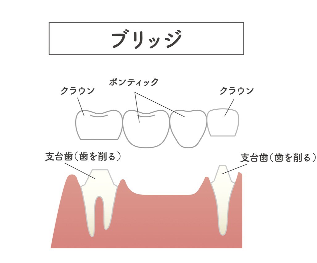 ブリッジ治療