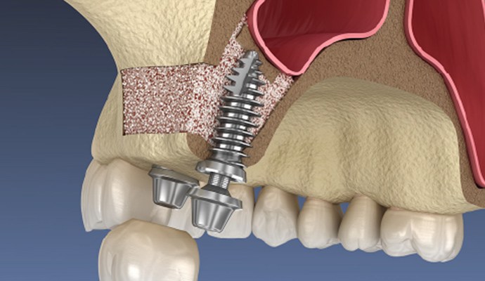 骨量不足の方でもインプラント手術は可能