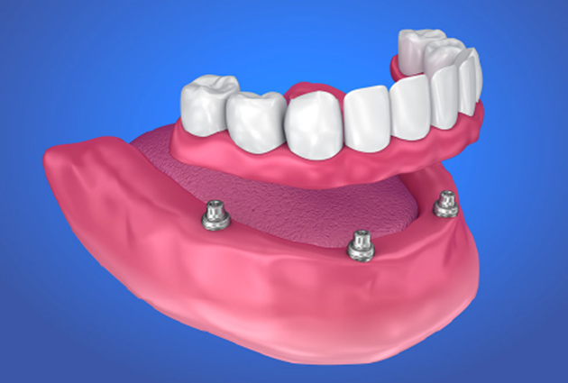 インプラントオーバーデンチャーとは