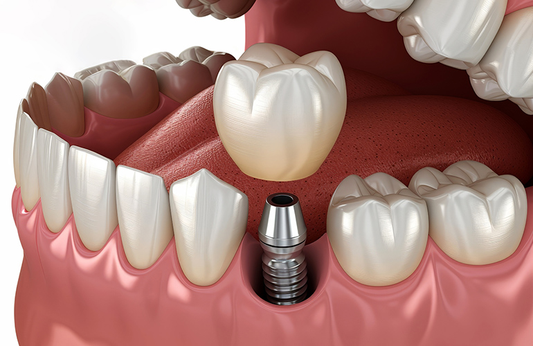 インプラント治療は、失った歯を補う“第二の永久歯”