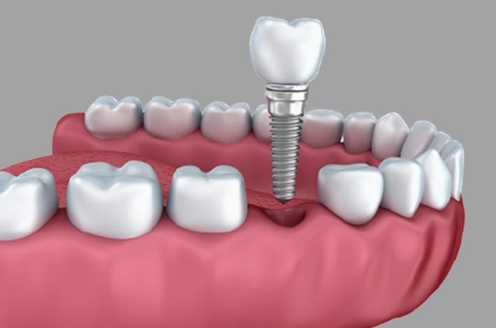 サージカルガイドで正確な埋入を実現