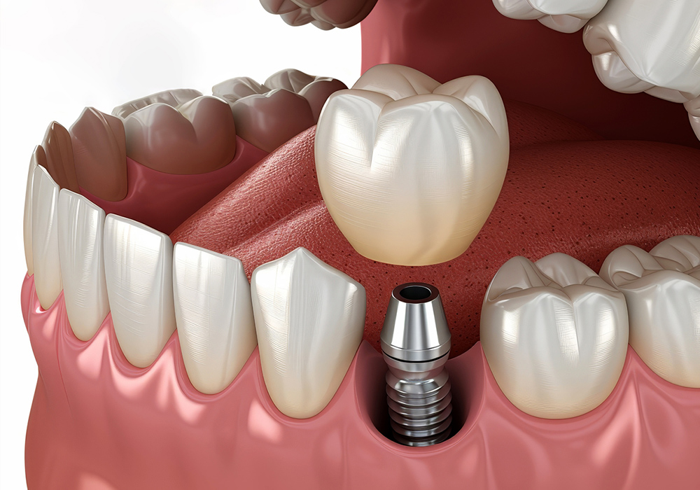 インプラント治療は、失った歯を補う“第二の永久歯”