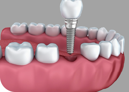 サージカルガイドで正確な埋入を実現