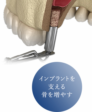 インプラントを支える骨を増やす